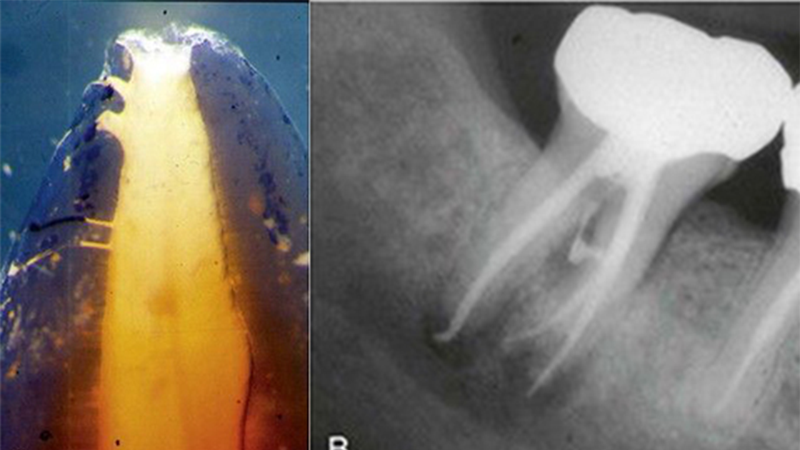 Conform Fit Gutta-Percha Points: Precise root canal fit | Dentsply ...