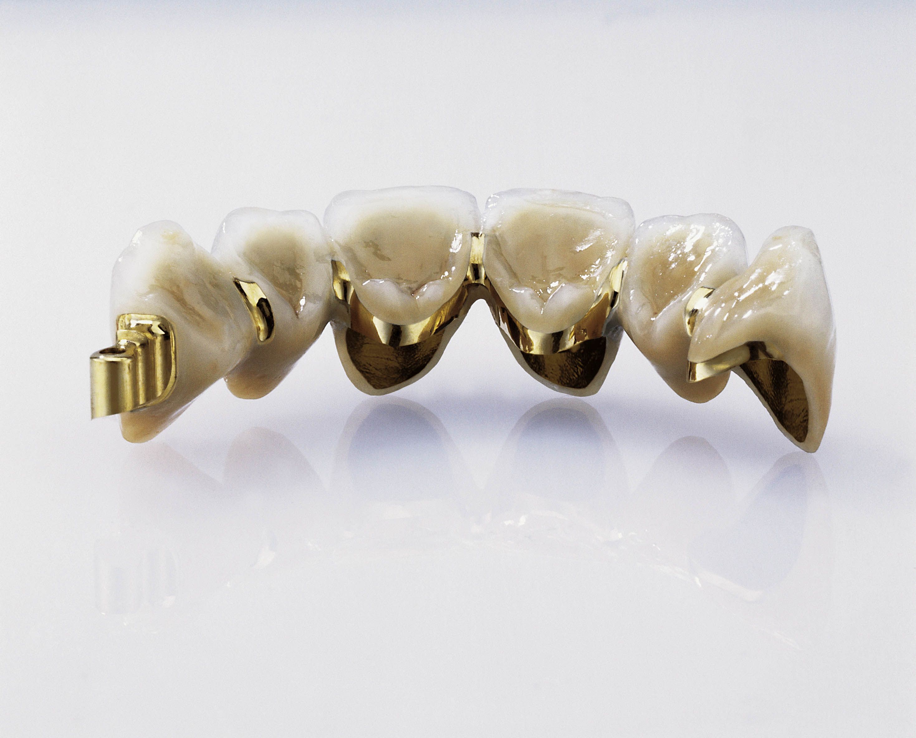 Metal-Based Crown \u0026 Bridge Materials | Dentsply Sirona USA, image size:2939x2368