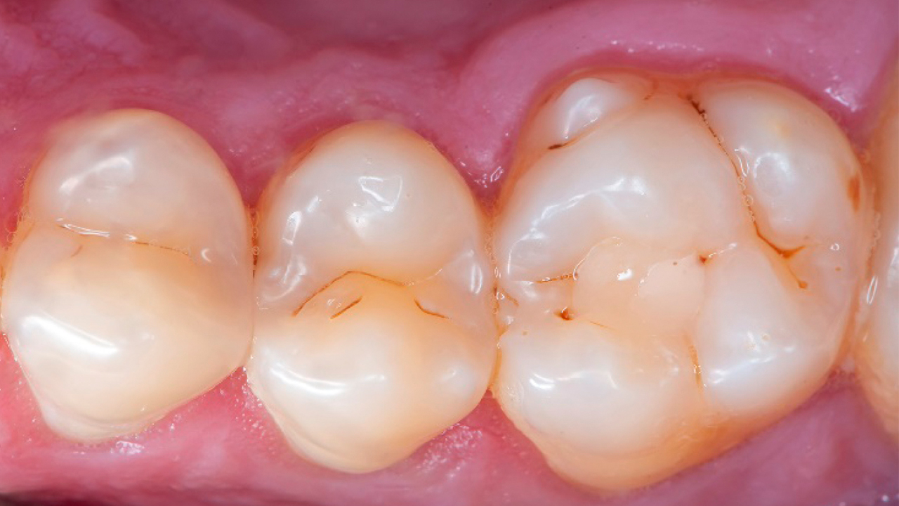 Distal Occlusal Restoration in Asymptomatic Patient | Dentsply