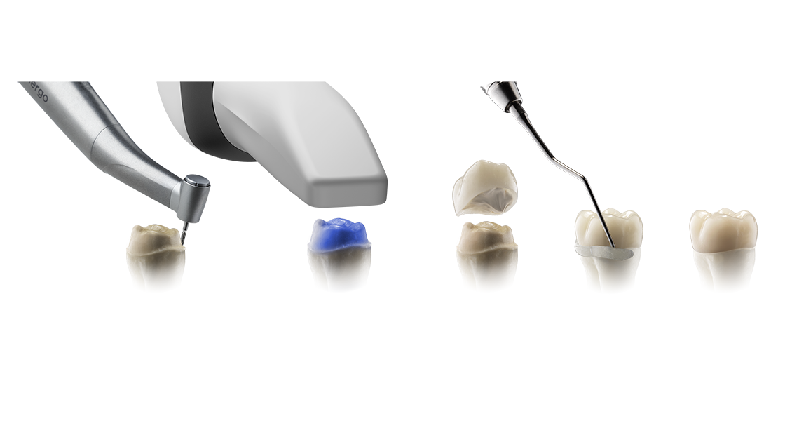 Digital with Lab Single Unit Crown Workflow USA